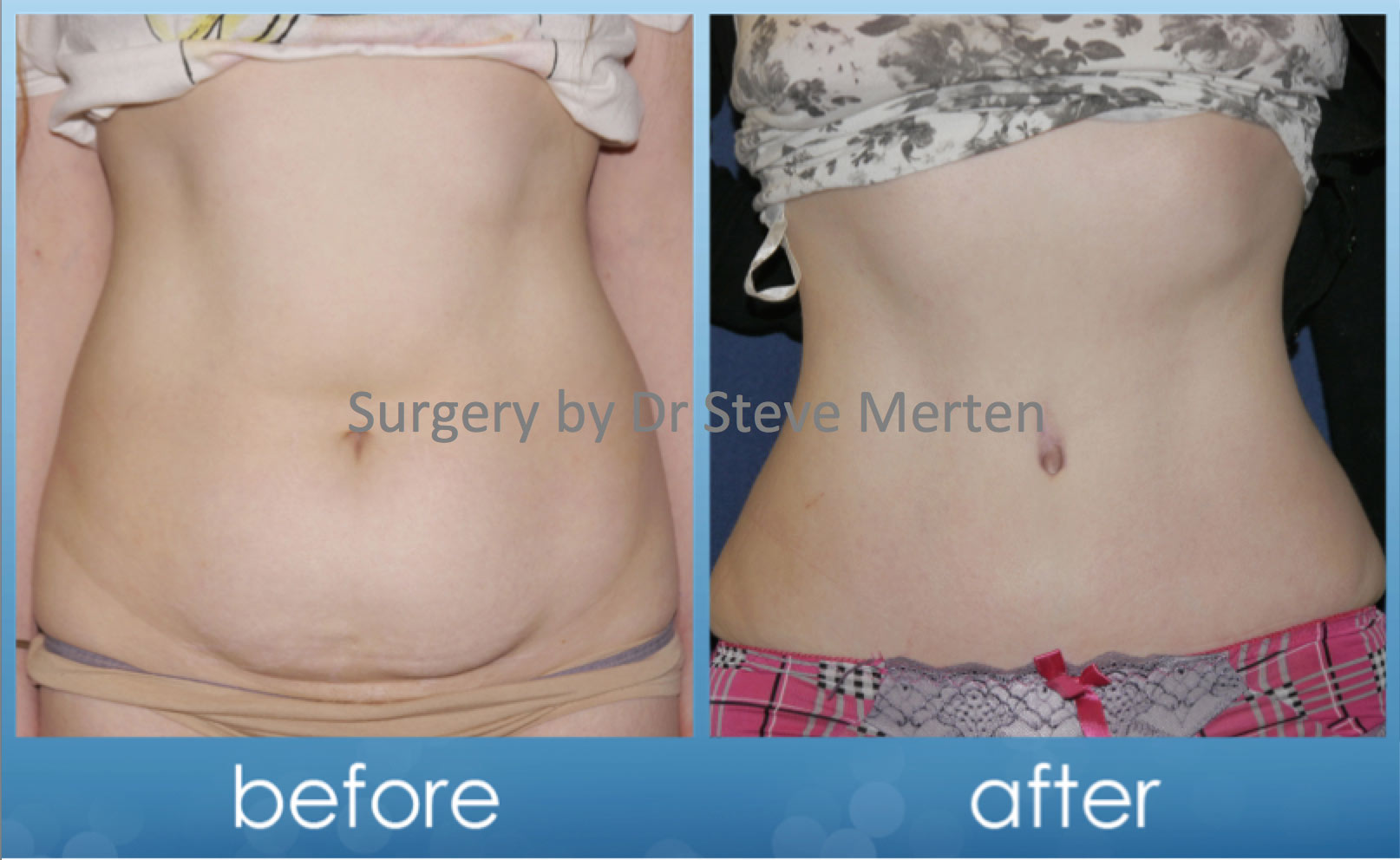 Plastic Surgery After Weight-Loss Surgery Plastic Surgery After Weight-Loss Surgery new foto Plastic Surgery After Weight-Loss Surgery Plastic Surgery After Weight-Loss Surgery new foto