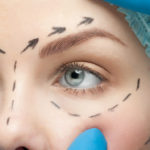 eyelid surgery sydney