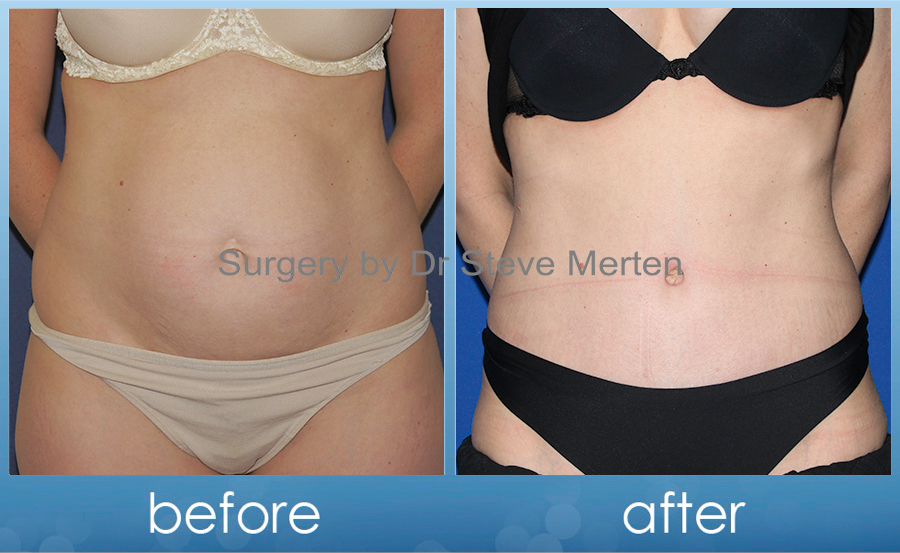 3 d tummy tuck and breast augmentation surgery pics 167