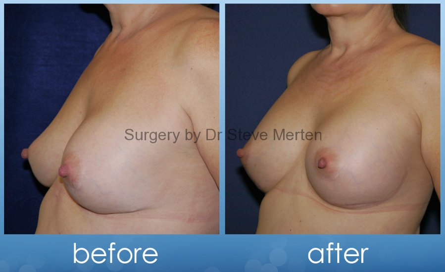 Have thought Deflated saline breast You tell Deflated saline breast consider, that