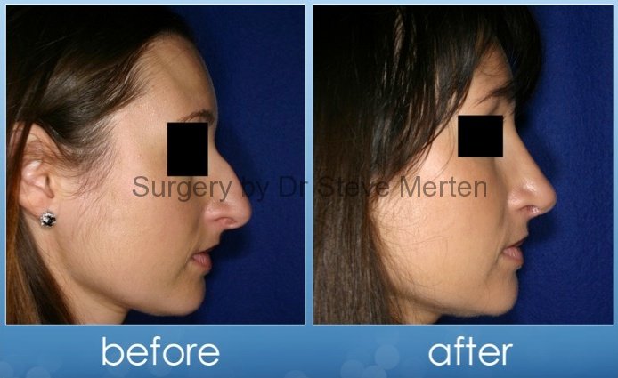 Average Cost Of Nose Job In Australia Job Retro