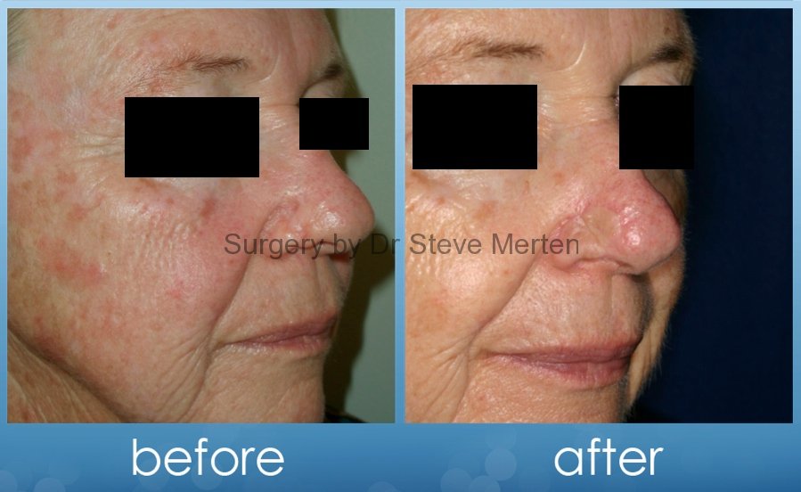 Please treatments for facial skin cancer Treatments for facial skin cancer absolutely