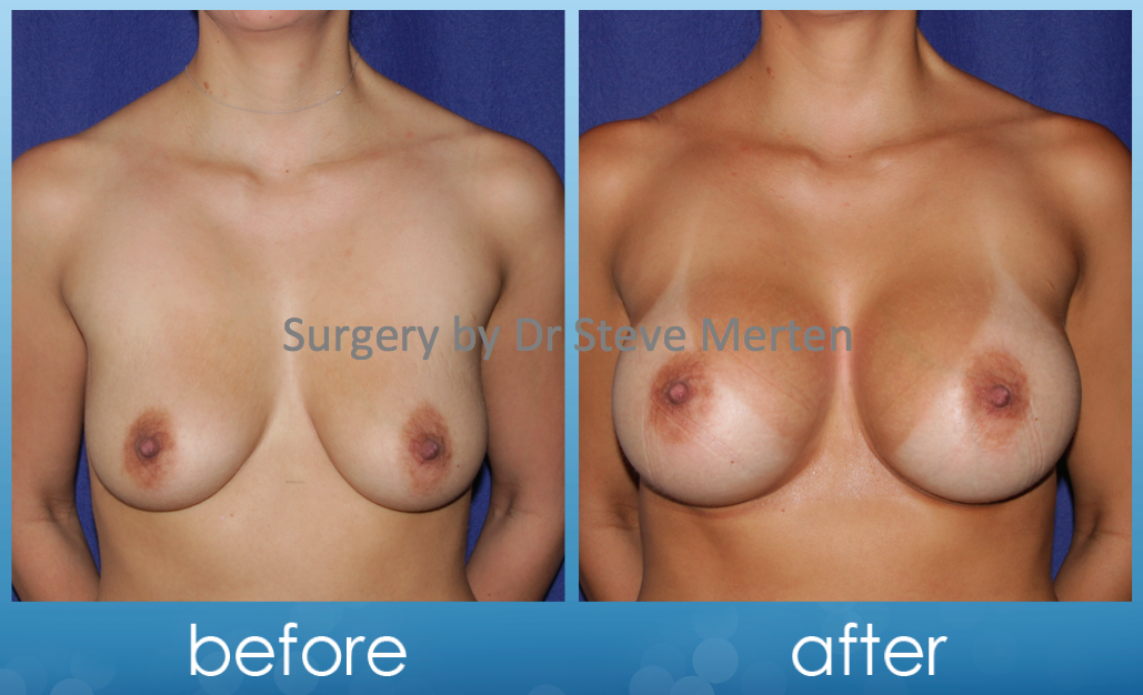 Apologise, but, enlarging mens breast Consider, that enlarging mens breast And have