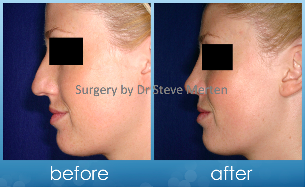 Average Cost Of Nose Job In Australia Job Retro